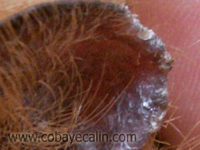 teigne du bord de l'oreille