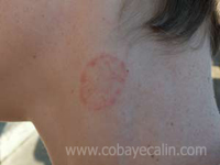 teigne animale sur un humain