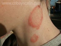 teigne animale sur un humain mal diagnostiqu&eacute;